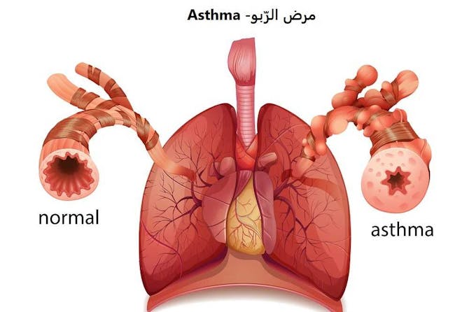مرض الر بو Asthma طب تايم