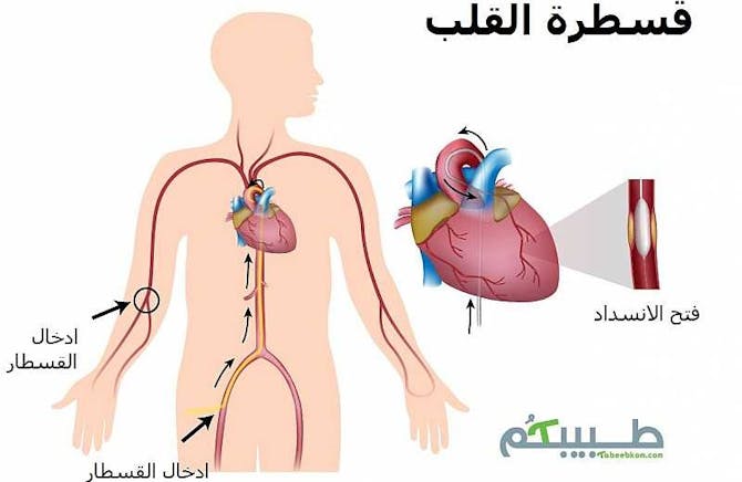 قسطرة القلب ام جراحة القلب طب تايم