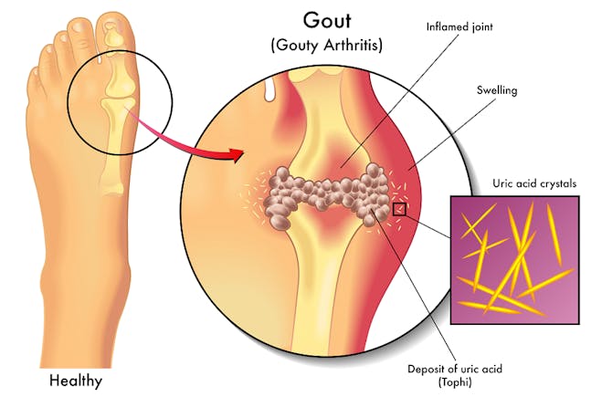 داء النقرس Gout Disease طب تايم